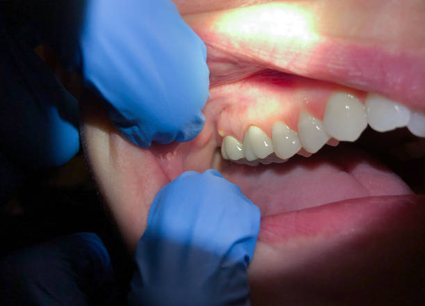 Best Emergency Wisdom Teeth Removal in Island Park, NY